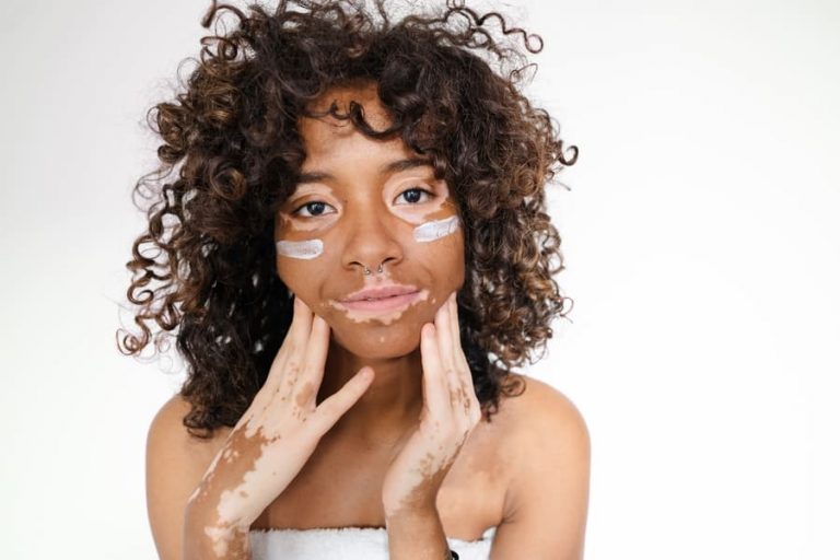 rosto de mulher jovem que possui pele com vitiligo