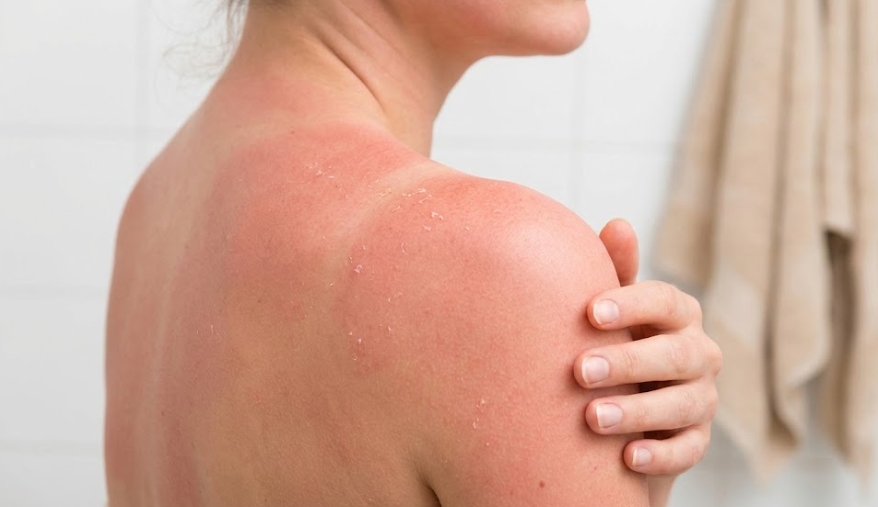 Close na pele avermelhada com leve ressecamento, evidenciando fragilidade da barreira cutânea.